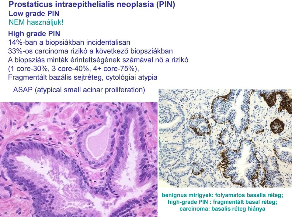 érintettségének számával nő a rizikó (1 core-30%, 3 core-40%, 4+ core-75%), Fragmentált bazális sejtréteg, cytológiai