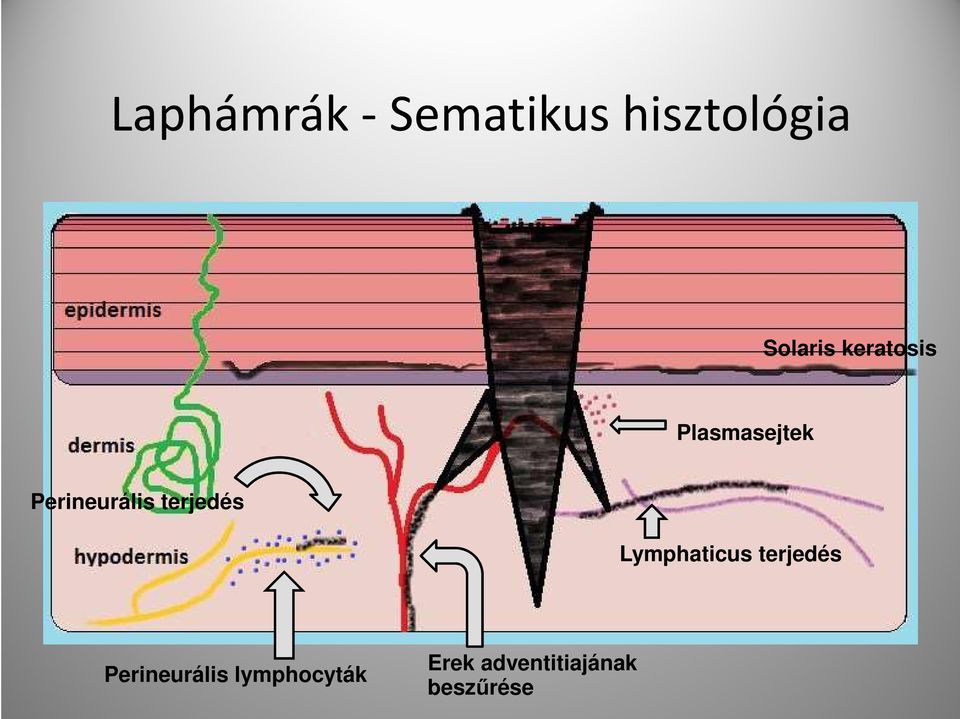 Perineurális terjedés Lymphaticus terjedés