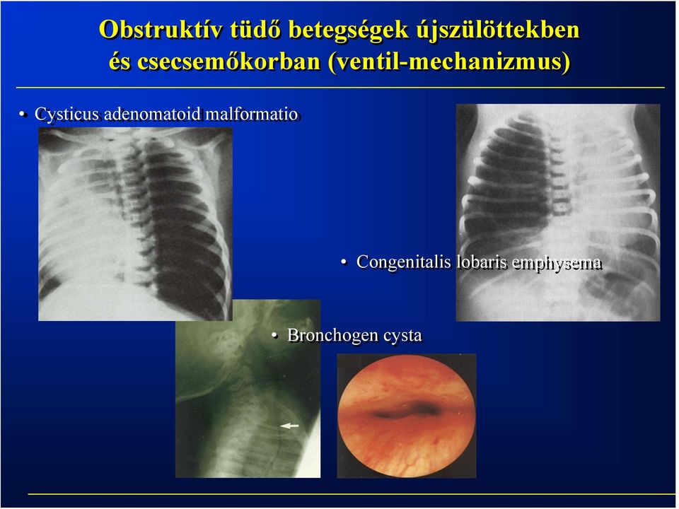 (ventil-mechanizmus) Cysticus