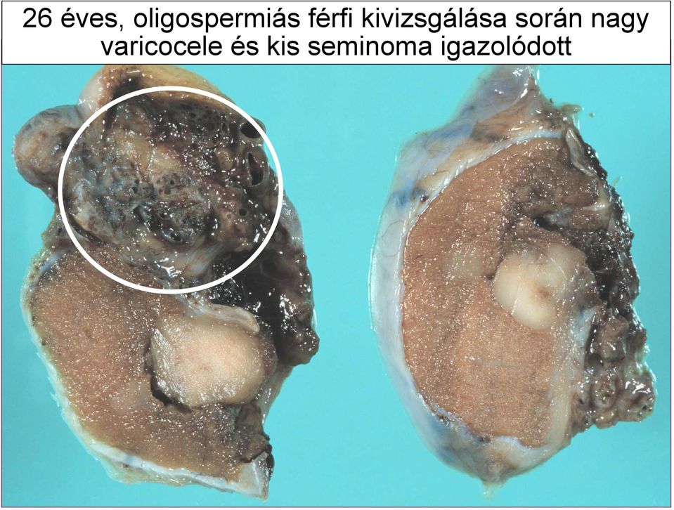 során nagy varicocele