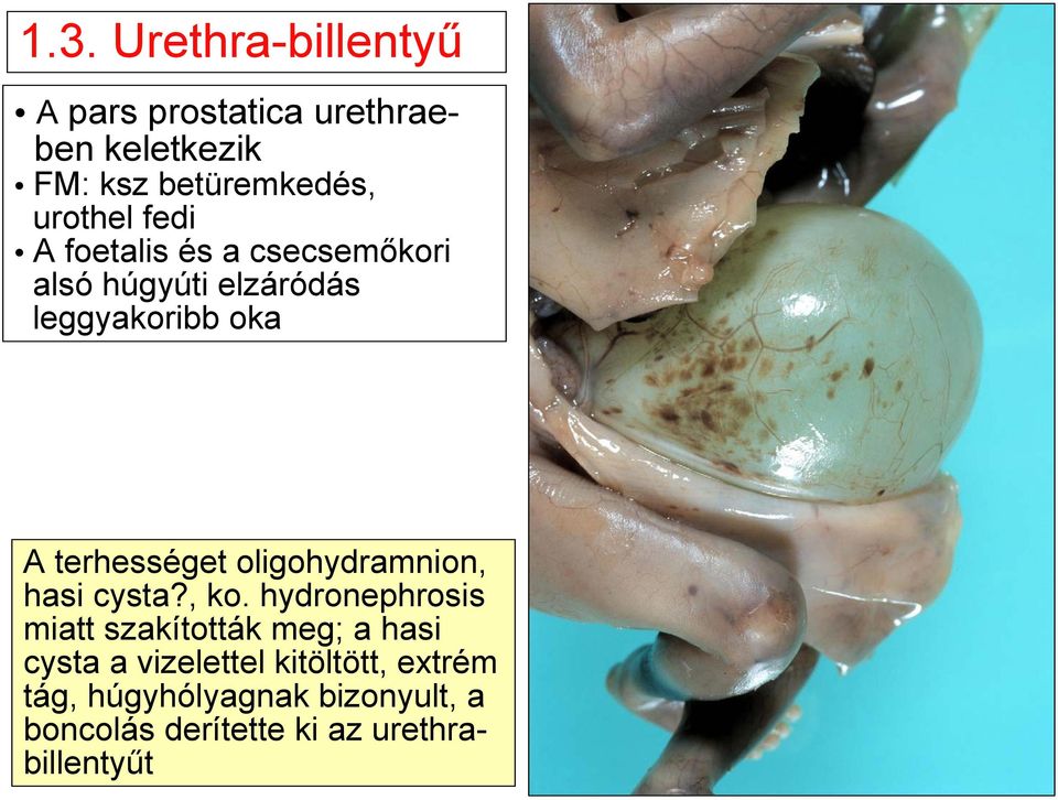 terhességet oligohydramnion, hasi cysta?, ko.