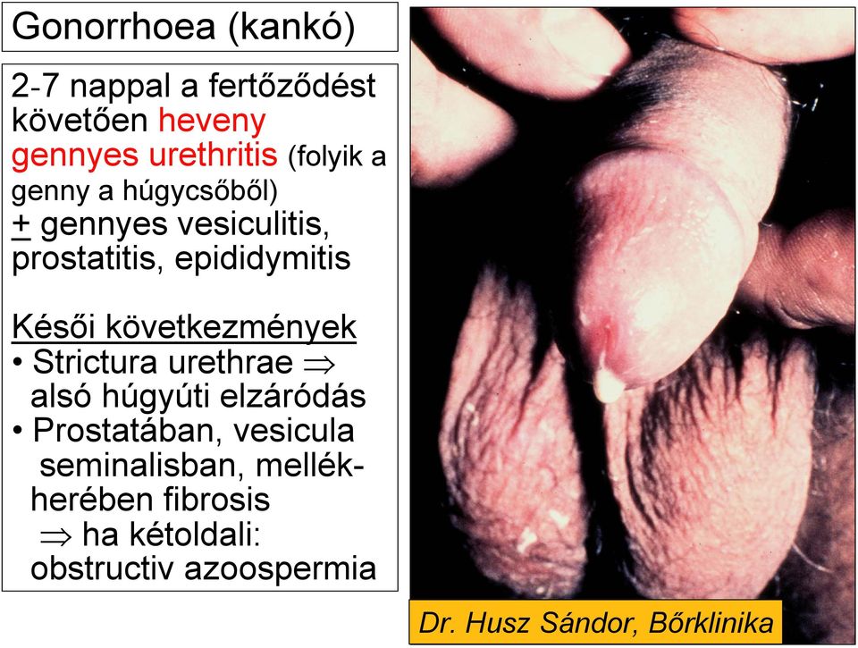 következmények Strictura urethrae alsó húgyúti elzáródás Prostatában, vesicula