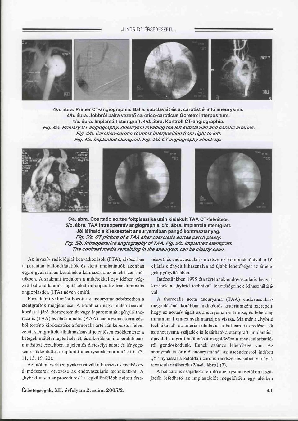 lmplanted stentgraft FU. 4/d. CTangiography check-up. Sla. äbra. Coartatio aortae foltplasztika utän kialakult TAA CT-felv6tele. 5/b. äbra. TAA intraoperativ angiographia. Slc. äbra.lmplantält stentgraft.