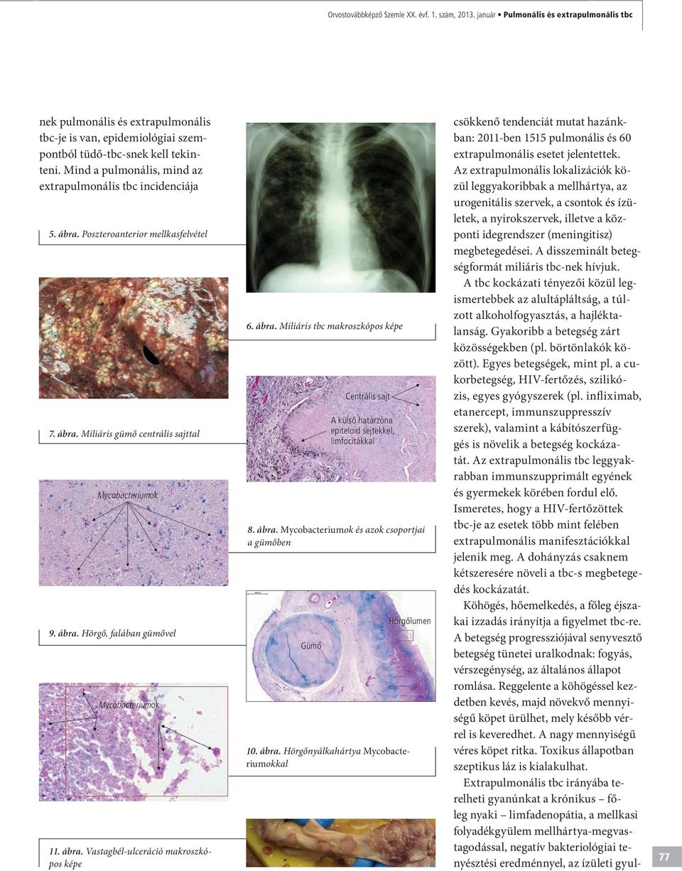 Extrapulmonális manifesztációt is mutató tbc tanulságos eseteink  áttekintése - PDF Ingyenes letöltés