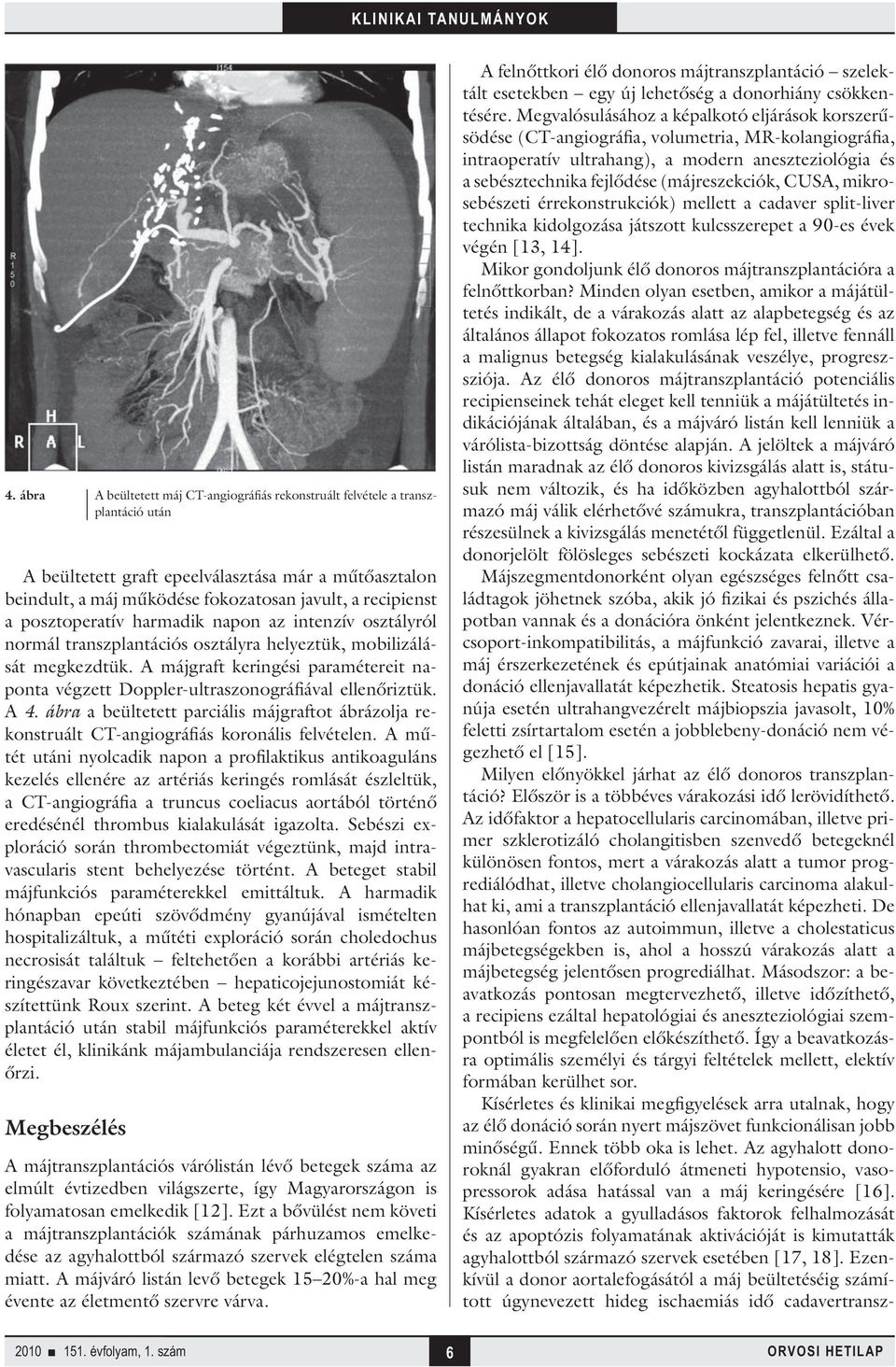 A májgraft keringési paramétereit naponta végzett Doppler-ultraszonográfiával ellenőriztük. A 4. ábra a beültetett parciális májgraftot ábrázolja rekonstruált CT-angiográfiás koronális felvételen.