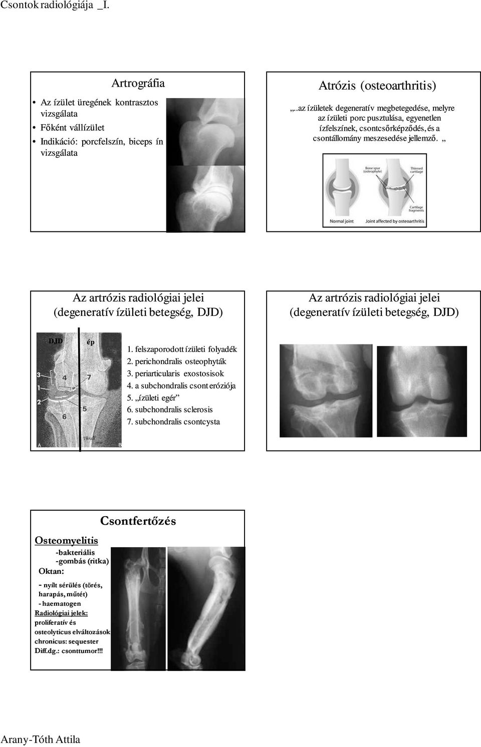 Az artrózis radiológiai jelei (degeneratív ízületi betegség, DJD) Az artrózis radiológiai jelei (degeneratív ízületi betegség, DJD) DJD ép 1. felszaporodott ízületi folyadék 2.