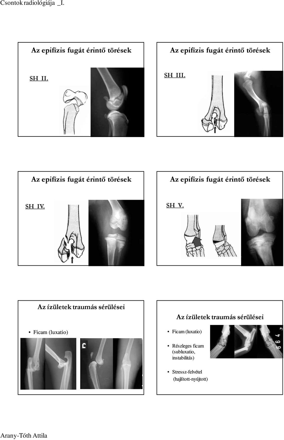 Az ízületek traumás sérülései Ficam (luxatio) Az ízületek traumás sérülései Ficam