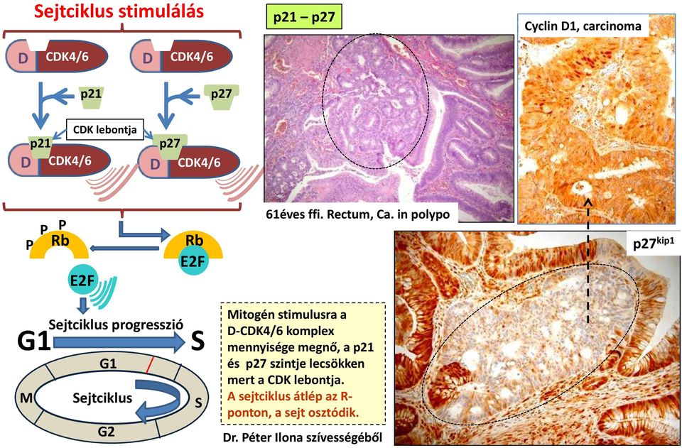in polypo p27 kip1 G1 Sejtciklus progresszió G1 M Sejtciklus G2 S S Mitogén stimulusra a D-CDK4/6