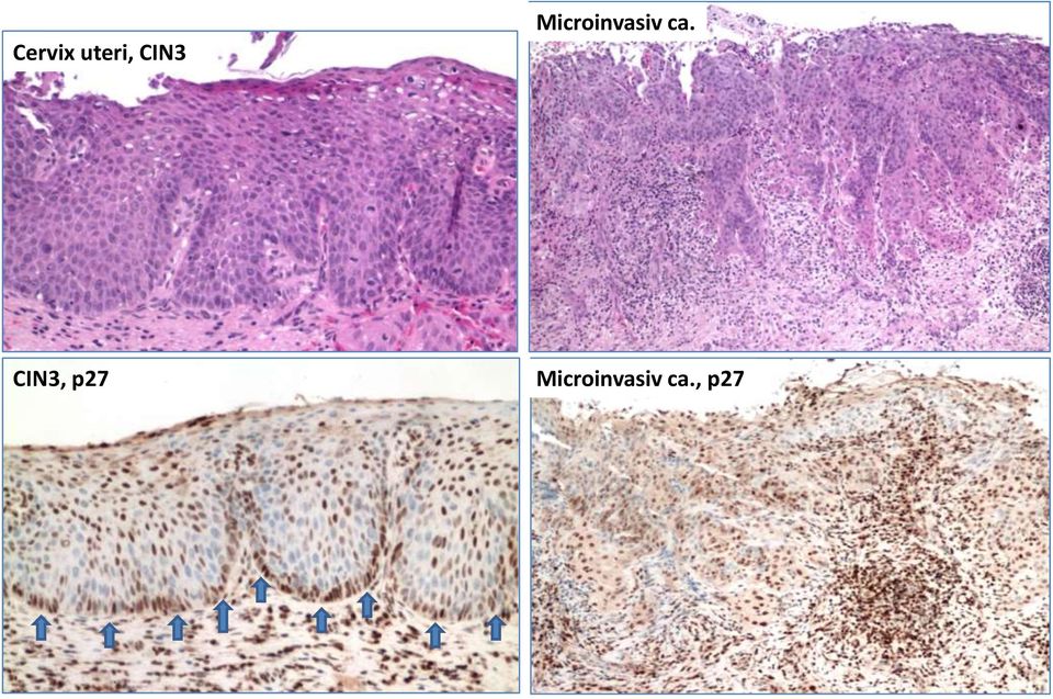 Microinvasiv ca.