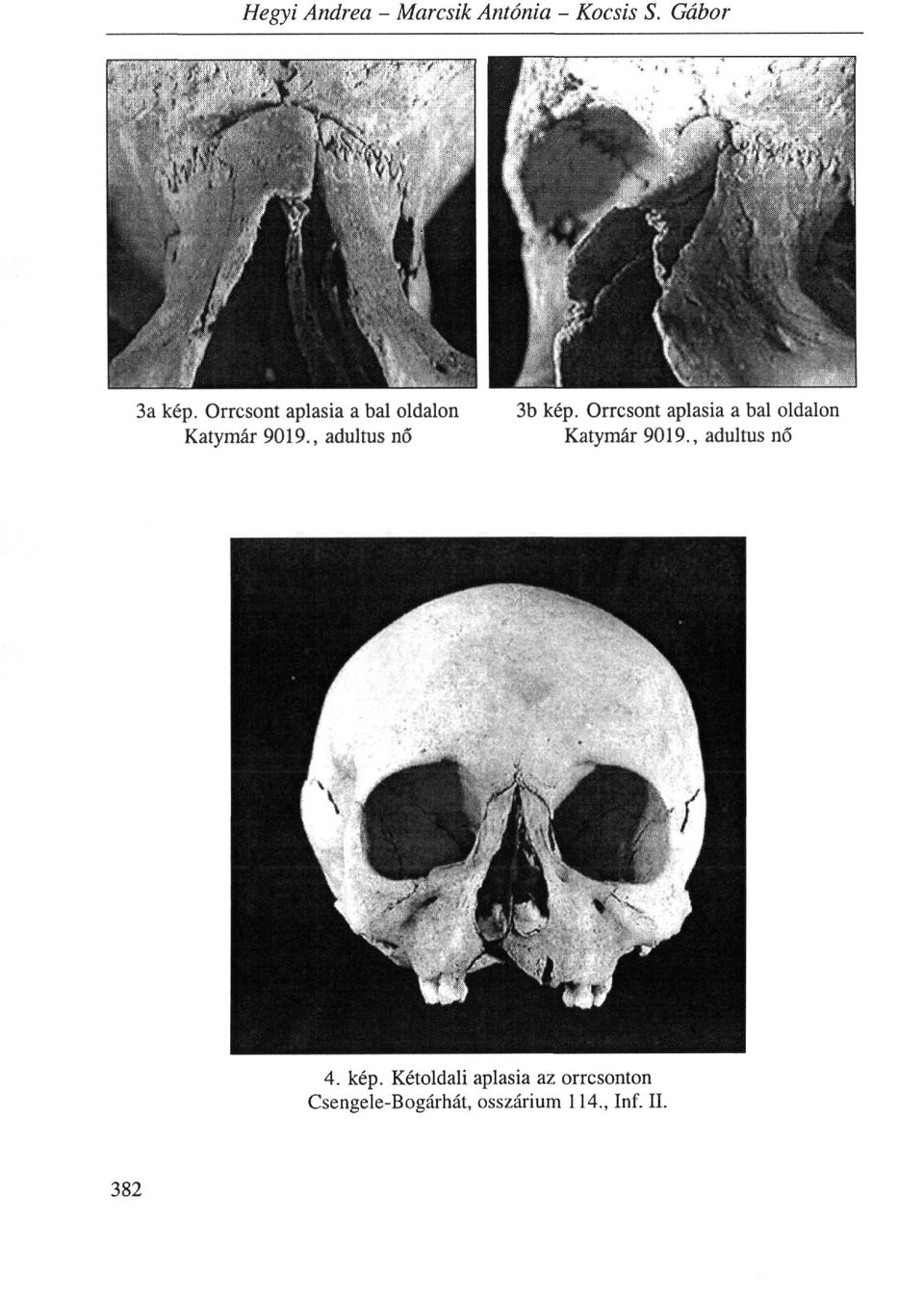 Orrcsont aplasia a bal oldalon Katymár 9019., adui tus nő 4. kép.