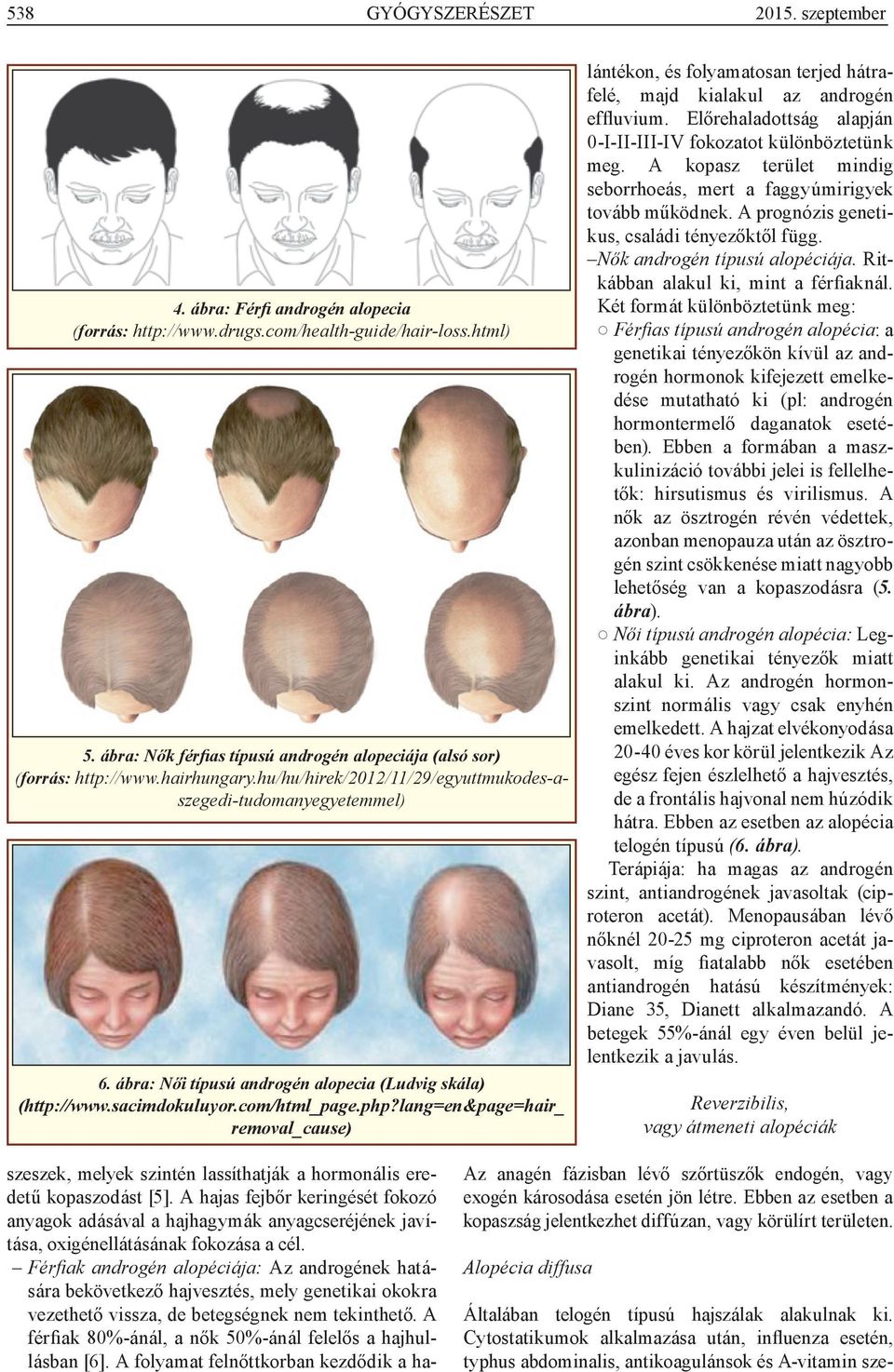 ábra: Női típusú androgén alopecia (Ludvig skála) (http://www.sacimdokuluyor.com/html_page.php?