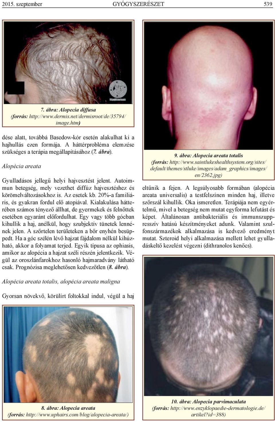 Alopécia areata Gyulladásos jellegű helyi hajvesztést jelent. Autoimmun betegség, mely vezethet diffúz hajvesztéshez és körömelváltozásokhoz is. Az esetek kb.