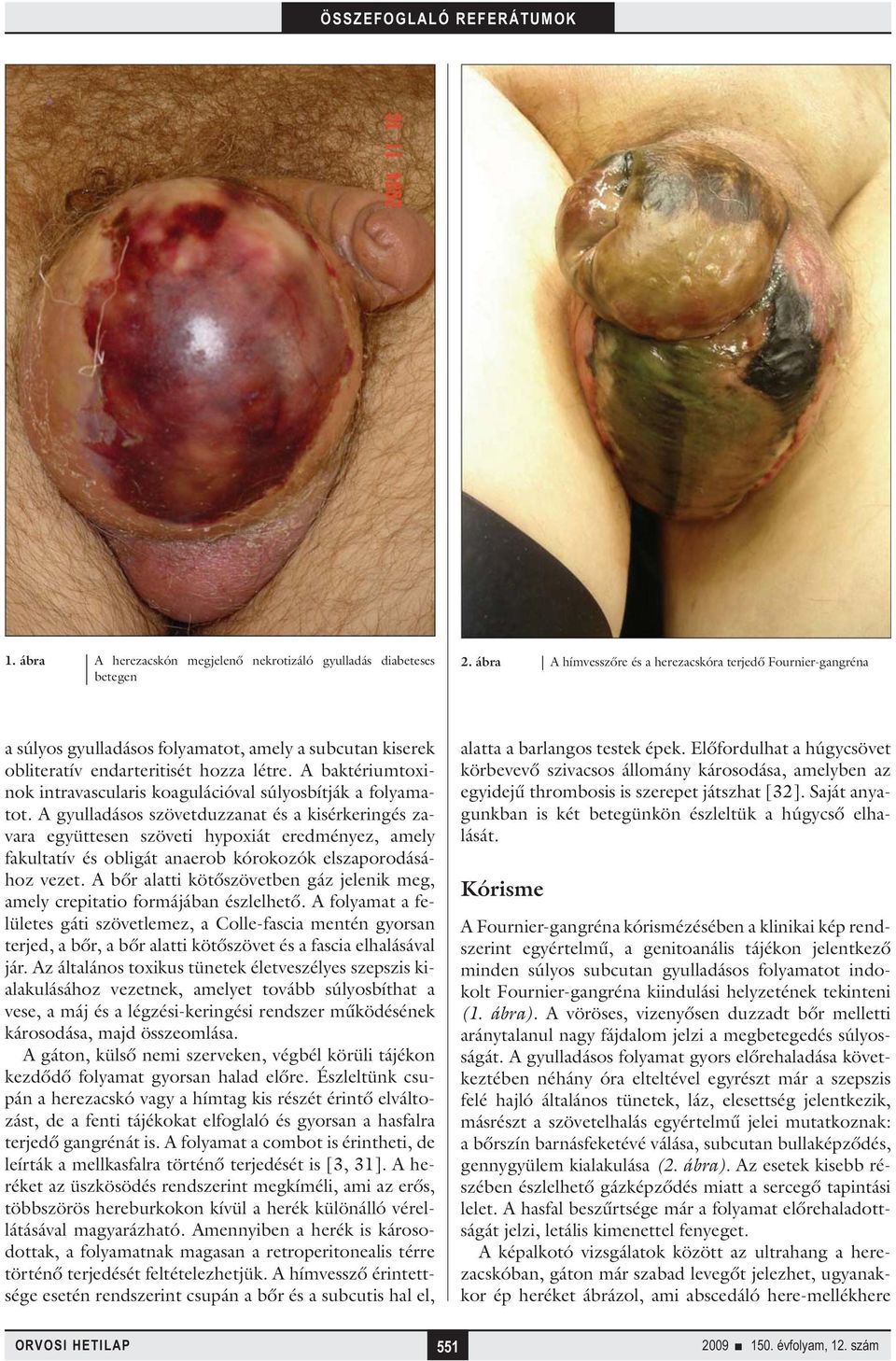 A baktériumtoxinok intravascularis koagulációval súlyosbítják a folyamatot.