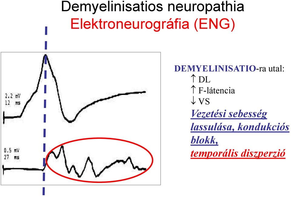 DEMYELINISATIO-ra utal: DL F-látencia VS