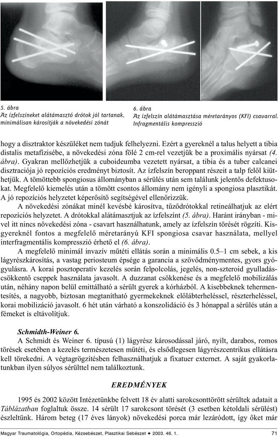 Ezért a gyereknél a talus helyett a tibia distalis metafízisébe, a növekedési zóna fölé 2 cm-rel vezetjük be a proximális nyársat (4. ábra).