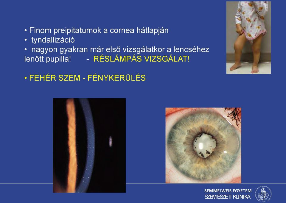 vizsgálatkor a lencséhez lenőtt pupilla!