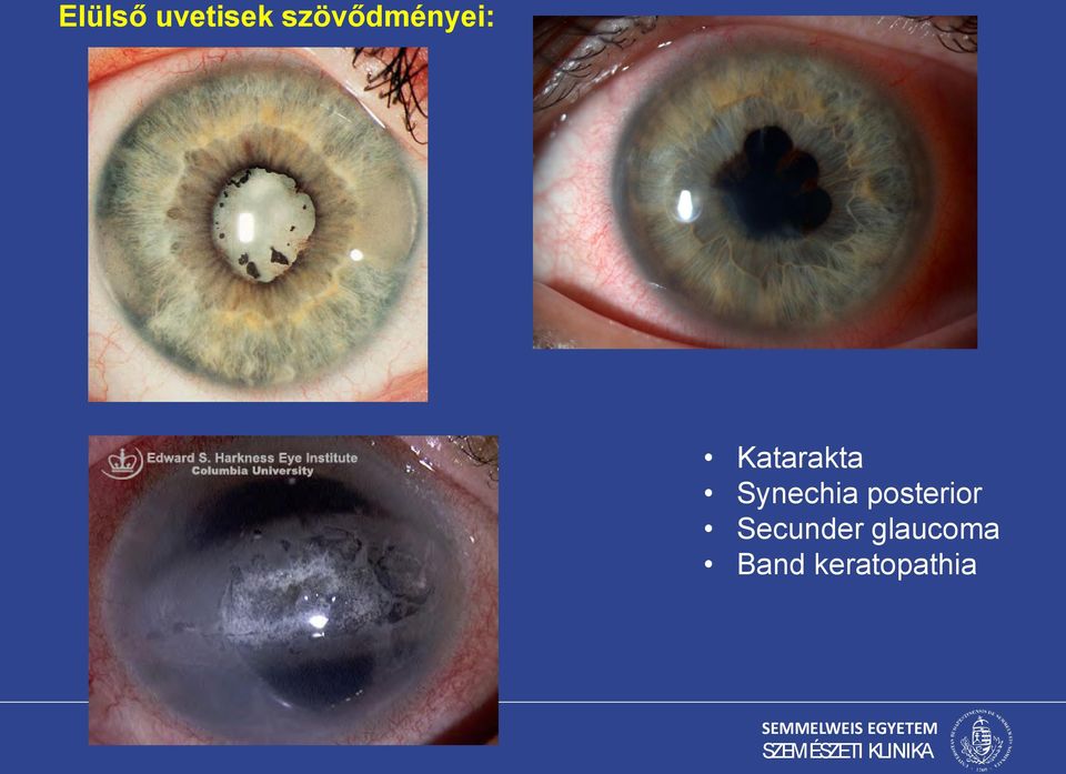 Synechia posterior