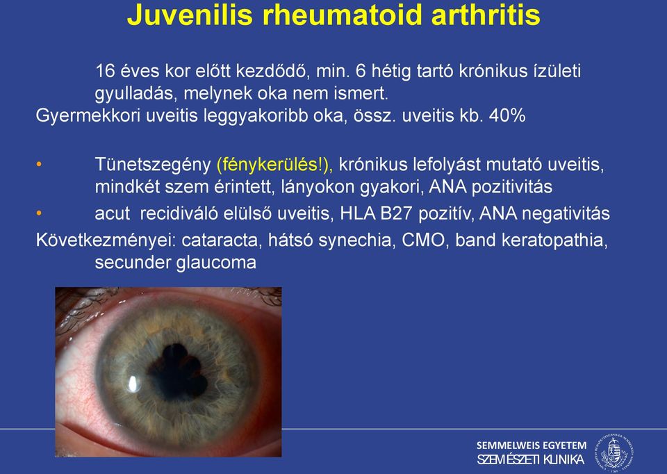 uveitis kb. 40% Tünetszegény (fénykerülés!