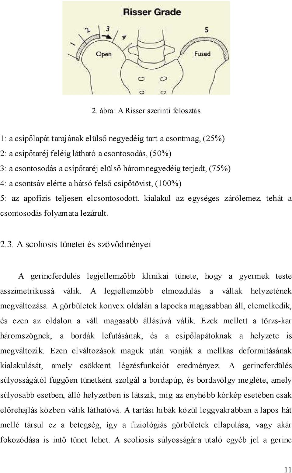 3. A scoliosis tünetei és szövıdményei A gerincferdülés legjellemzıbb klinikai tünete, hogy a gyermek teste asszimetrikussá válik. A legjellemzıbb elmozdulás a vállak helyzetének megváltozása.