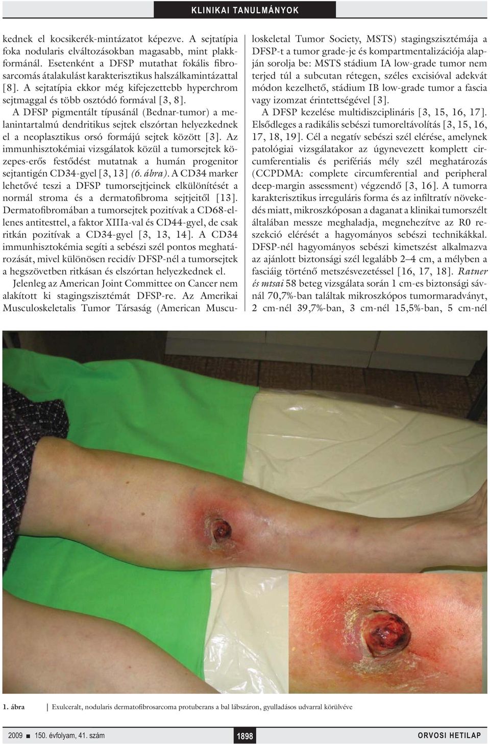 A DFSP pigmentált típusánál (Bednar-tumor) a melanintartalmú dendritikus sejtek elszórtan helyezkednek el a neoplasztikus orsó formájú sejtek között [].