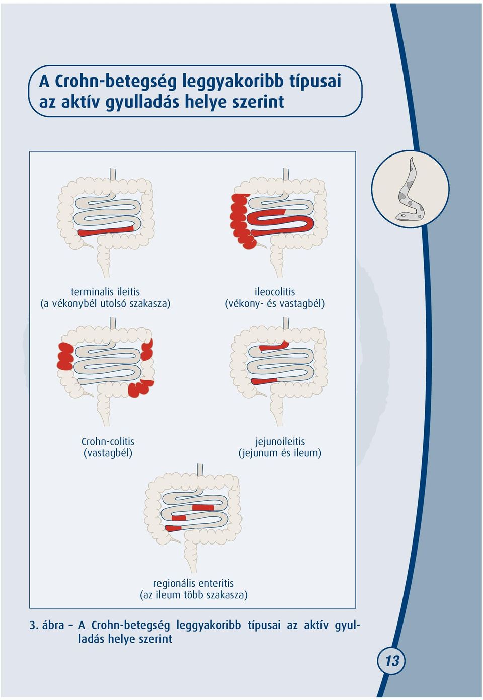 Crohn-colitis (vastagbél) jejunoileitis (jejunum és ileum) regionális enteritis (az