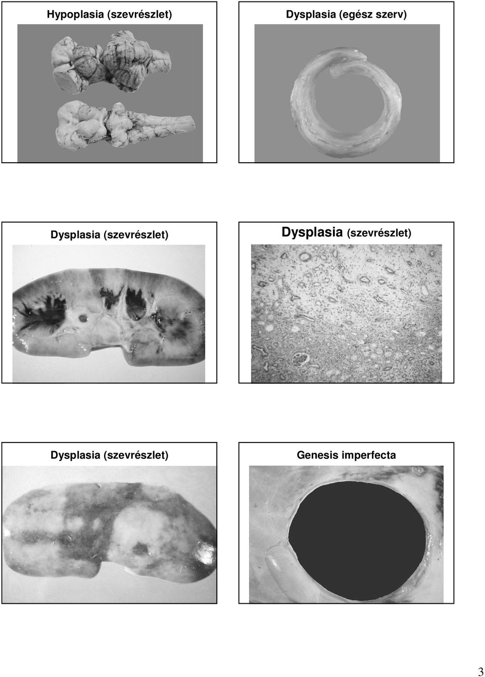 (szevrészlet) Dysplasia