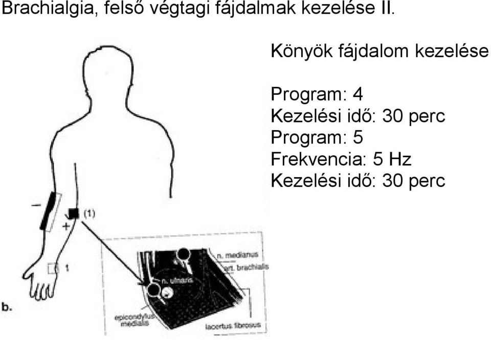 Könyök fájdalom kezelése Program: 4