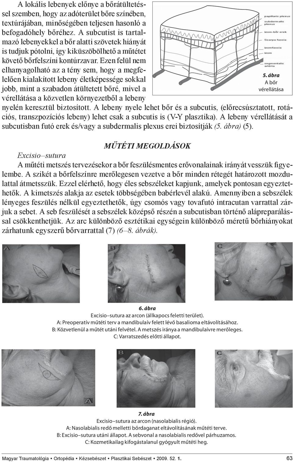 Ezen felül nem elhanyagolható az a tény sem, hogy a megfelelően kialakított lebeny életképessége sokkal jobb, mint a szabadon átültetett bőré, mivel a vérellátása a közvetlen környezetből a lebeny 5.