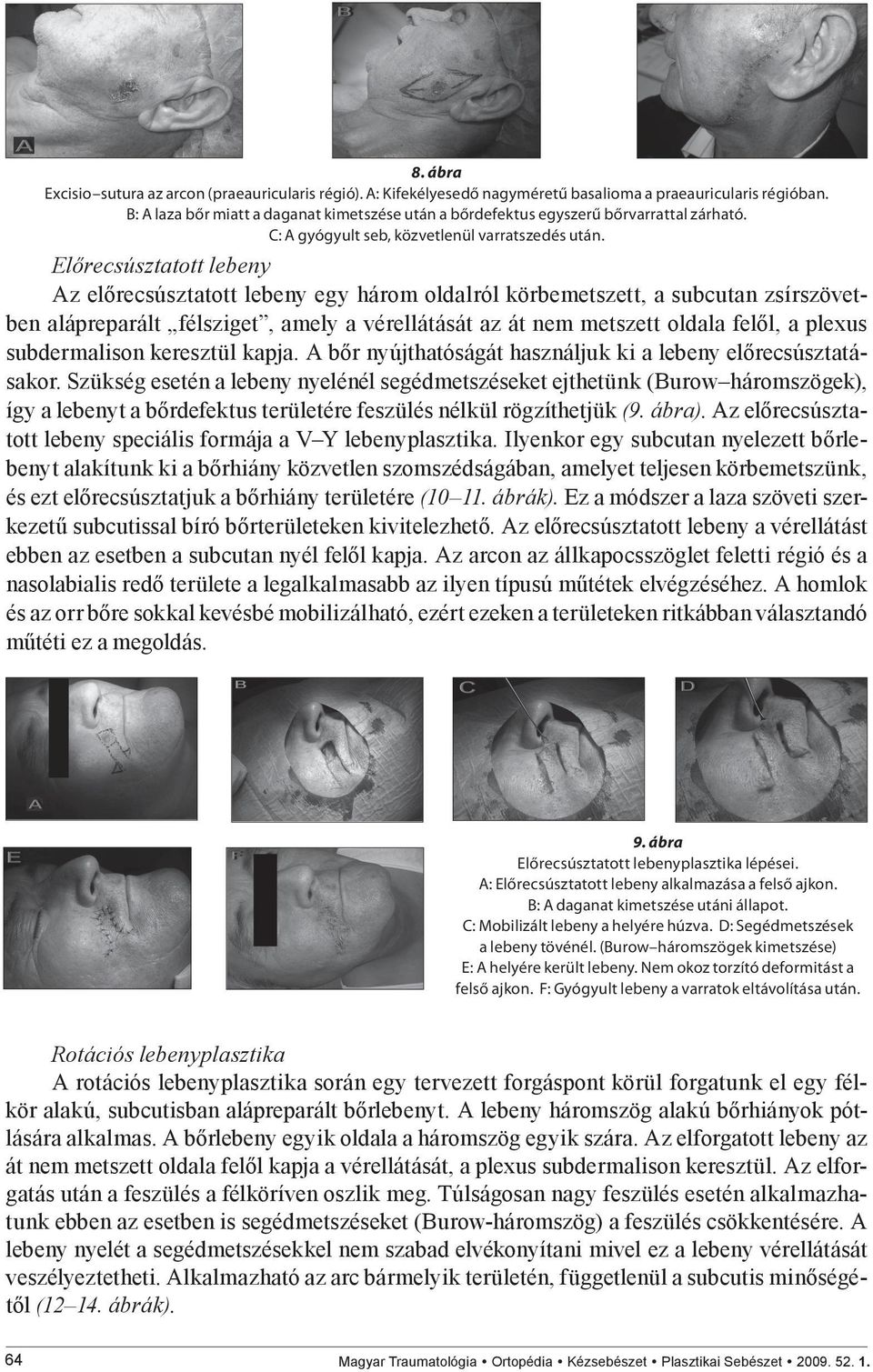 Előrecsúsztatott lebeny Az előrecsúsztatott lebeny egy három oldalról körbemetszett, a subcutan zsírszövetben alápreparált félsziget, amely a vérellátását az át nem metszett oldala felől, a plexus