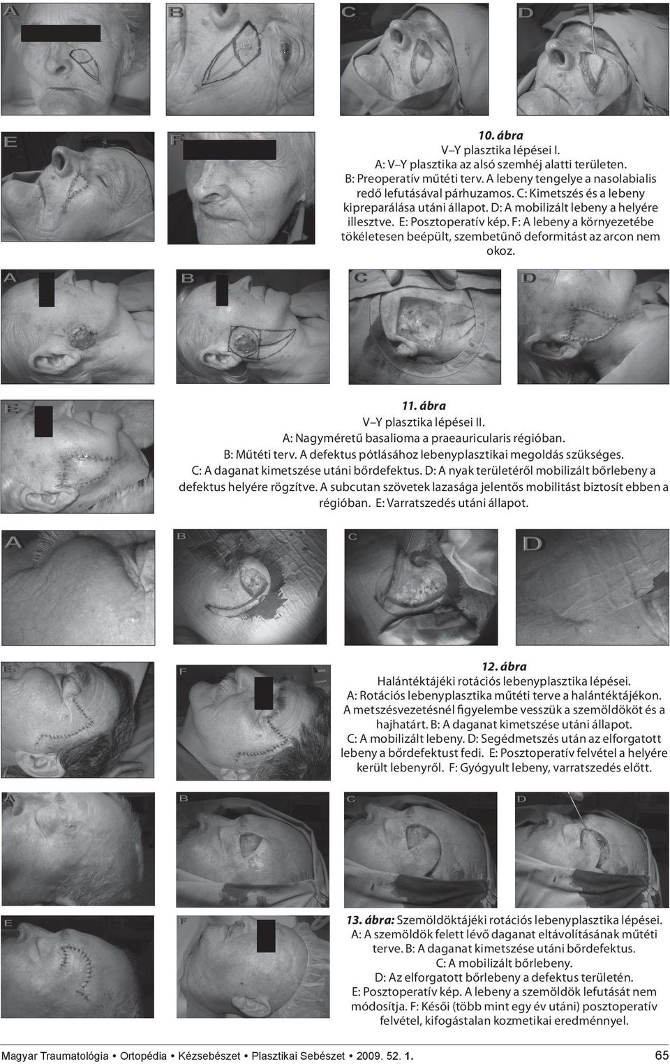 F: A lebeny a környezetébe tökéletesen beépült, szembetűnő deformitást az arcon nem okoz. 11. ábra V Y plasztika lépései II. A: Nagyméretű basalioma a praeauricularis régióban. B: Műtéti terv.