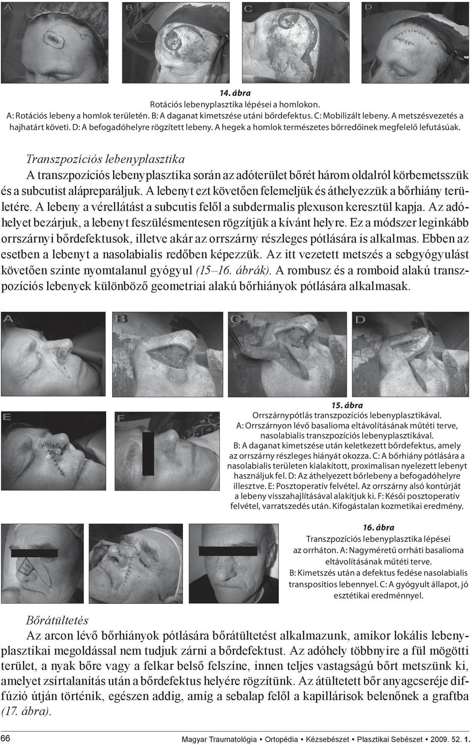 Transzpozíciós lebenyplasztika A transzpozíciós lebenyplasztika során az adóterület bőrét három oldalról körbemetsszük és a subcutist alápreparáljuk.