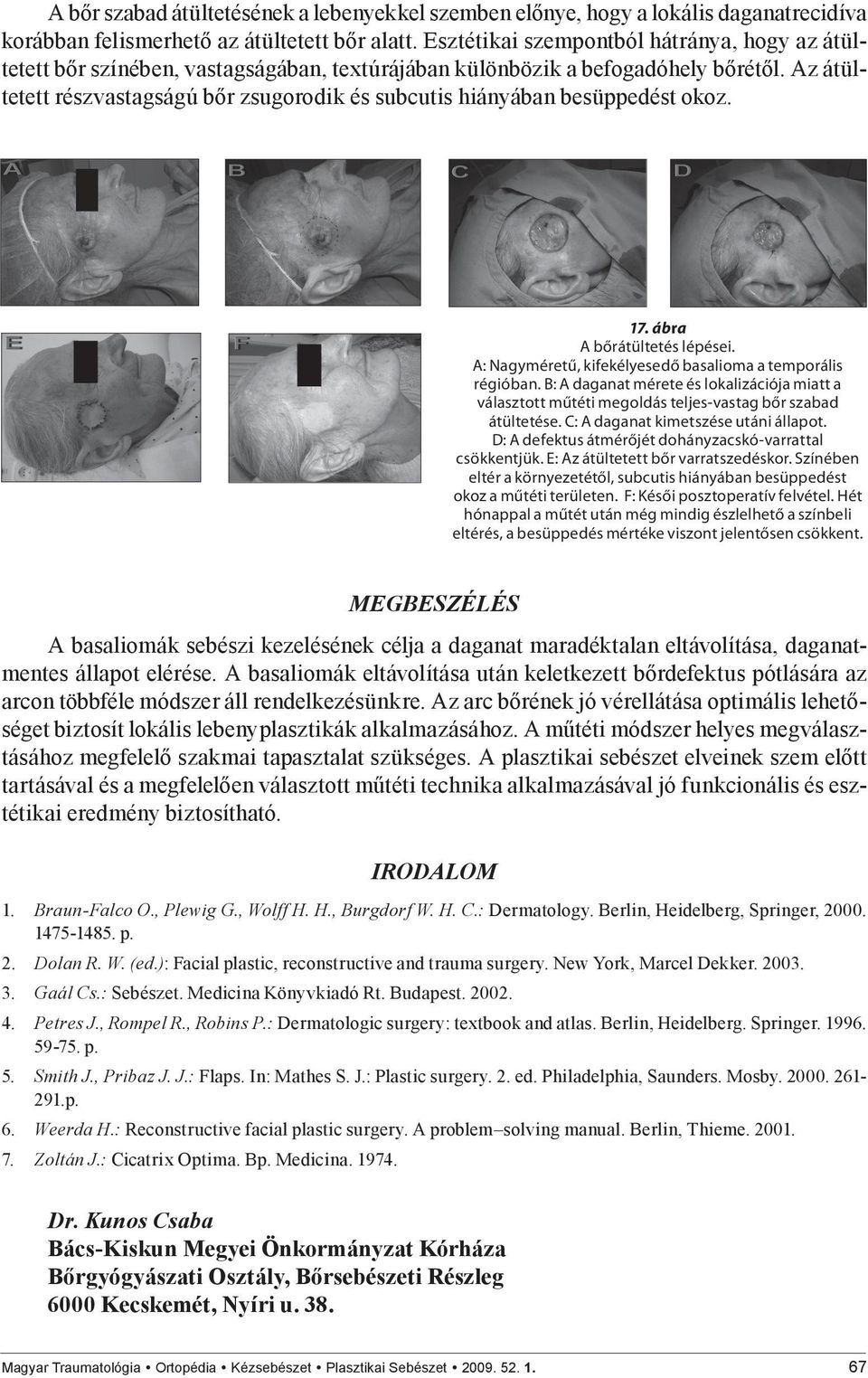 Az átültetett részvastagságú bőr zsugorodik és subcutis hiányában besüppedést okoz. 17. ábra A bőrátültetés lépései. A: Nagyméretű, kifekélyesedő basalioma a temporális régióban.