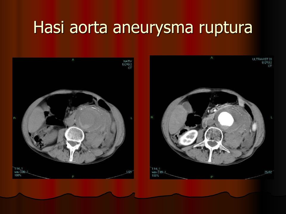 aneurysma