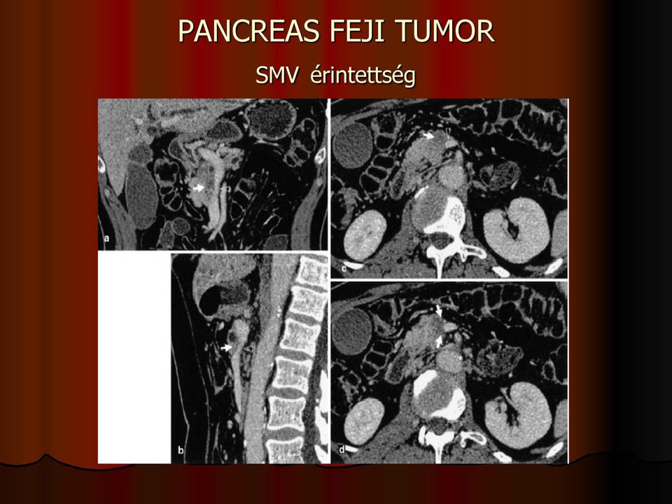 TUMOR SMV