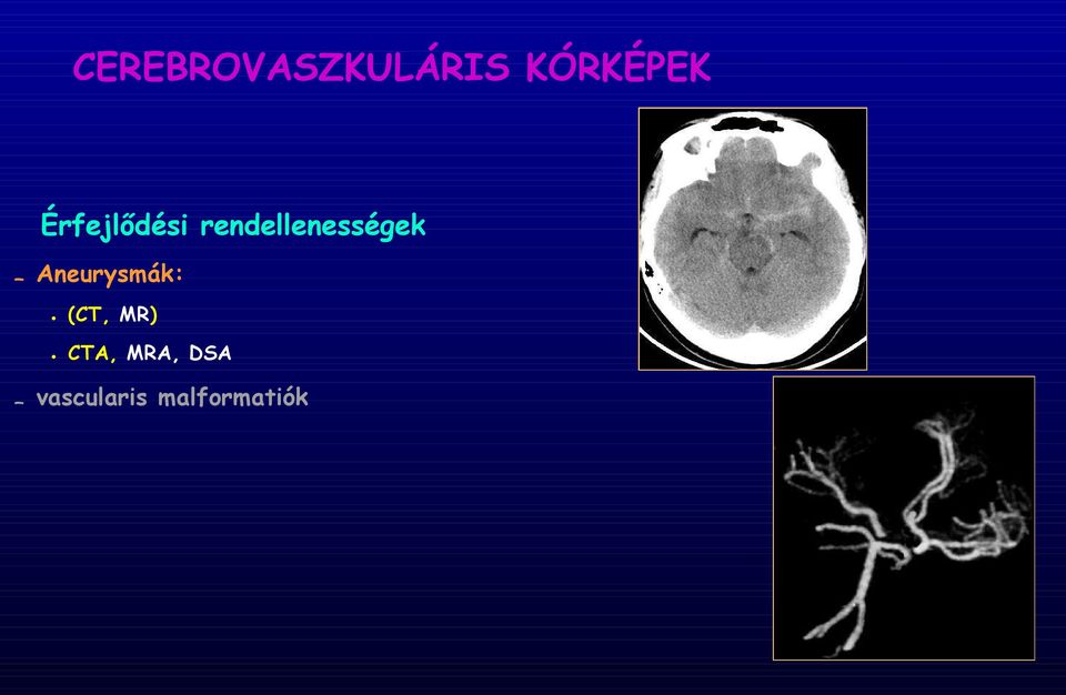 Aneurysmák: (CT, MR) CTA,