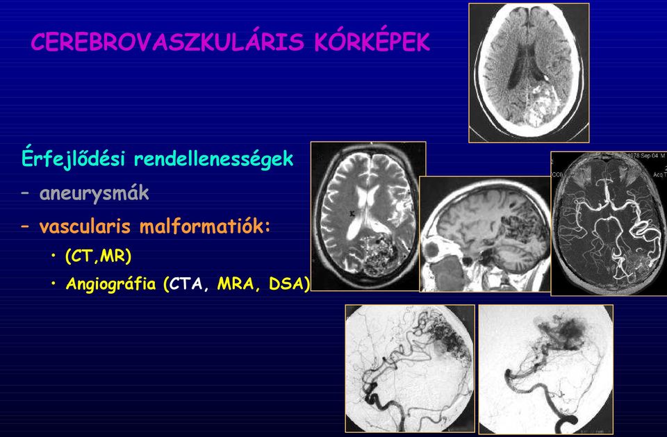 aneurysmák vascularis