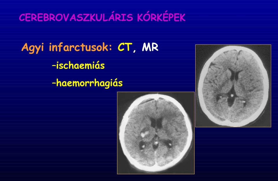 infarctusok: CT, MR