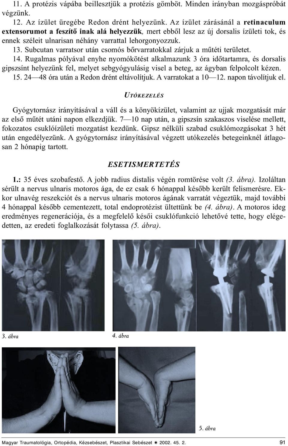 posztraumás artritisz az interfalangealis ízületben hogyan kezeljük az artrózist bicillinnel