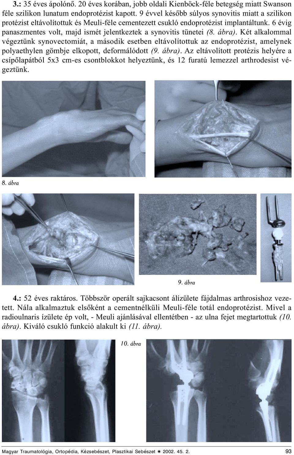 6 évig panaszmentes volt, majd ismét jelentkeztek a synovitis tünetei (8. ábra).