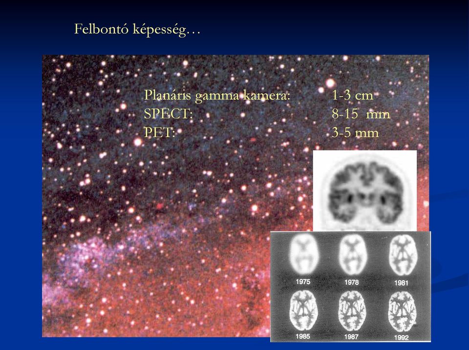 kamera: SPECT: