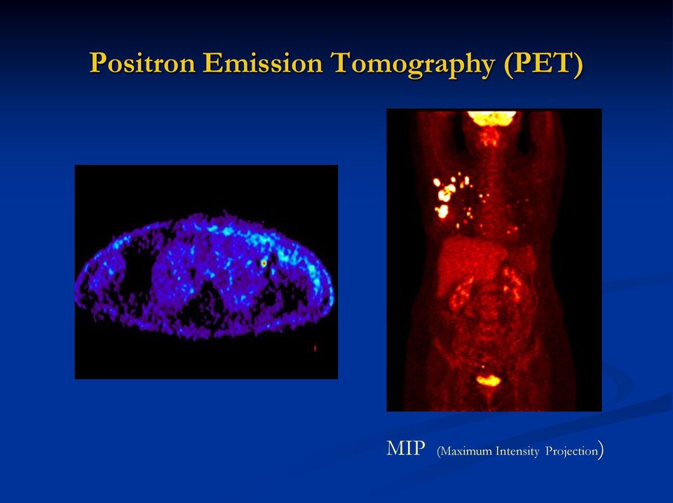 MIP (Maximum