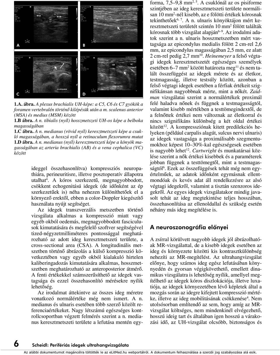 A n. medianus (nyíl) keresztmetszeti képe a könyök magasságában az arteria brachialis (AB) és a vena cephalica (VC) között B D ideggel összehasonlítva) kompressziós neuropathiára, perineuritisre,