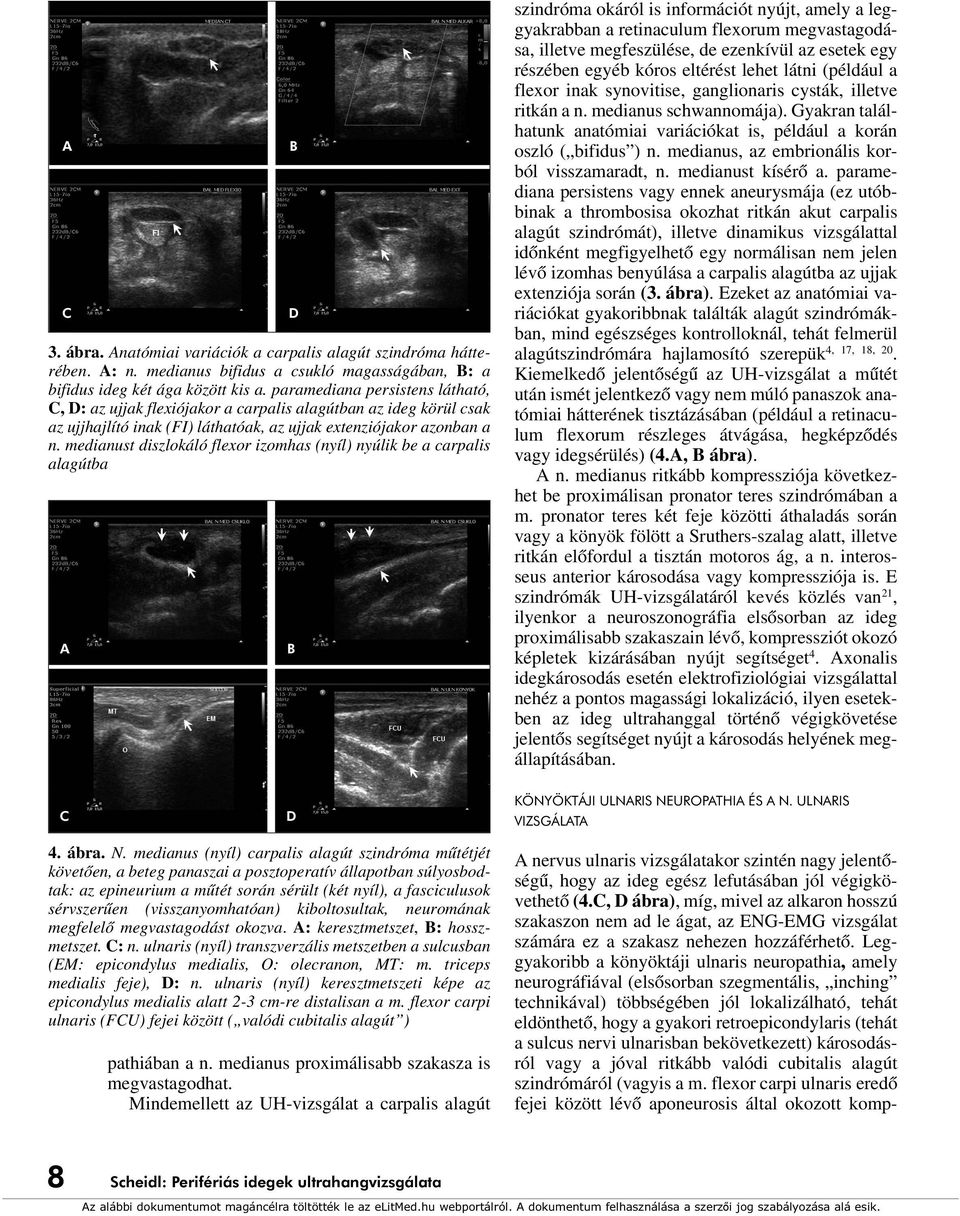 medianust diszlokáló flexor izomhas (nyíl) nyúlik be a carpalis alagútba A B D B szindróma okáról is információt nyújt, amely a leggyakrabban a retinaculum flexorum megvastagodása, illetve