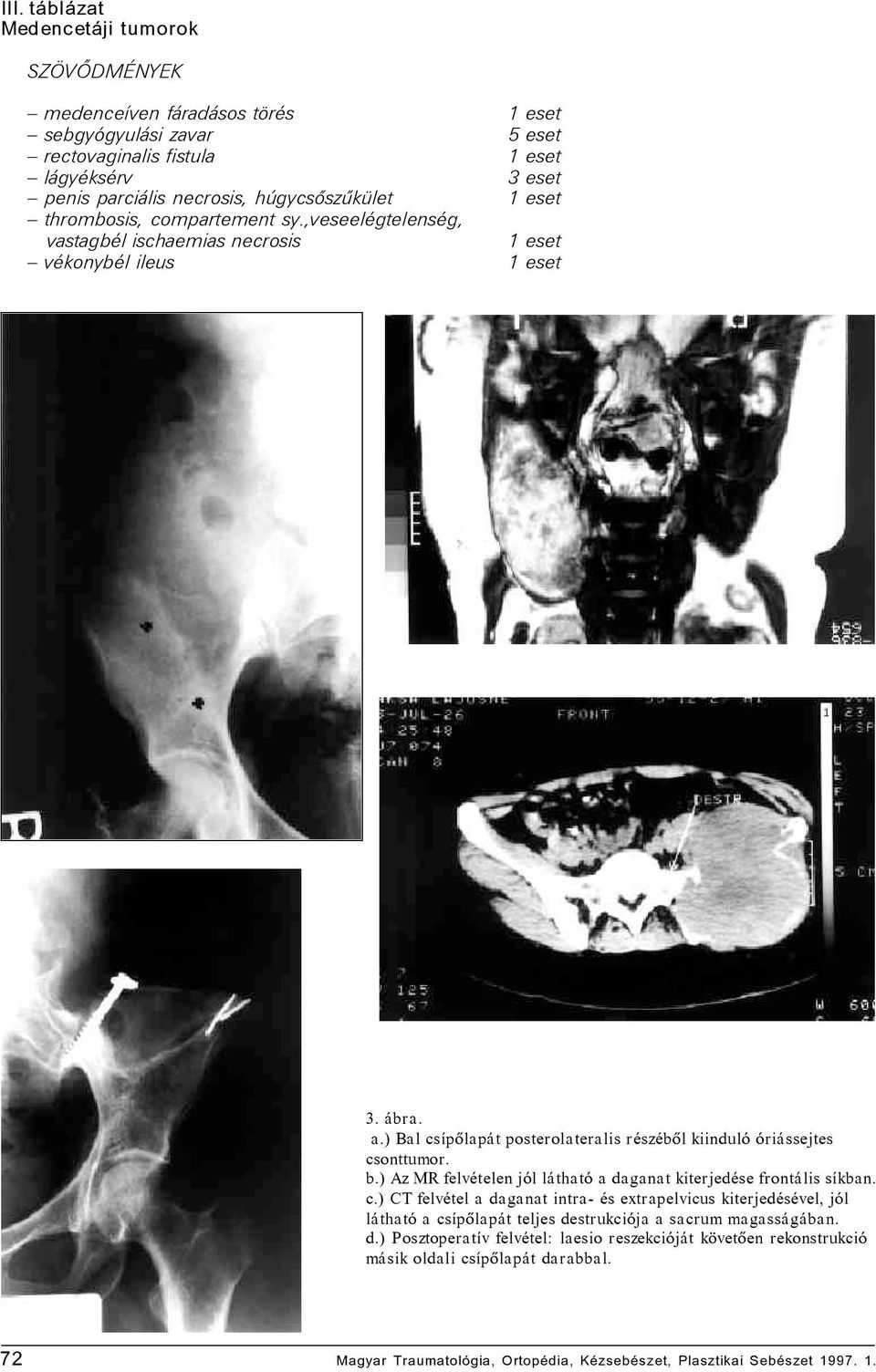 ) Bal csípõlapát posterolateralis részébõl kiinduló óriássejtes csonttumor. b.) Az MR felvételen jól látható a daganat kiterjedése frontális síkban. c.) CT felvétel a daganat intra- és extrapelvicus kiterjedésével, jól látható a csípõlapát teljes destrukciója a sacrum magasságában.