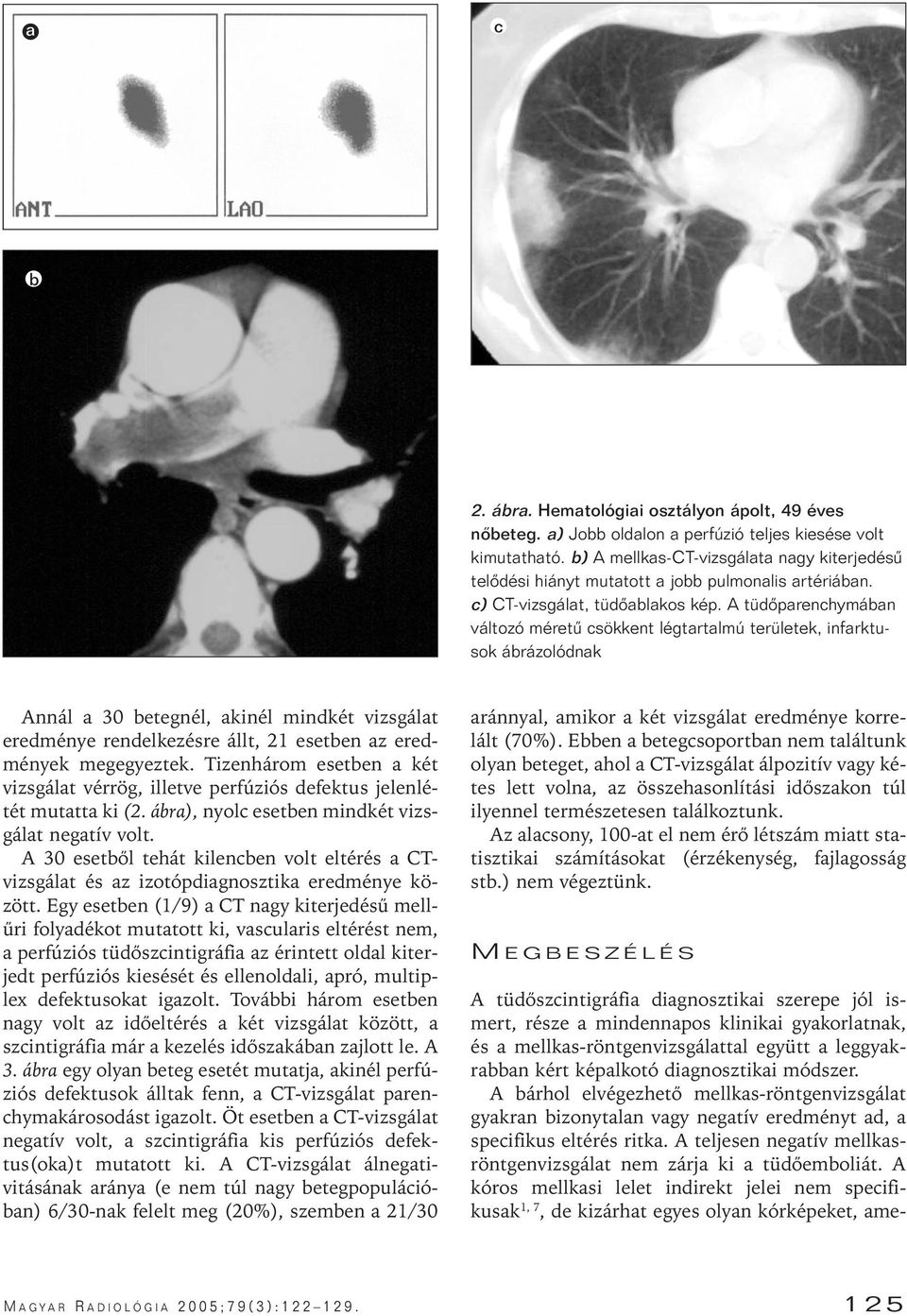 A tüdôparenchymában változó méretû csökkent légtartalmú területek, infarktusok ábrázolódnak Annál a 30 betegnél, akinél mindkét vizsgálat eredménye rendelkezésre állt, 21 esetben az eredmények