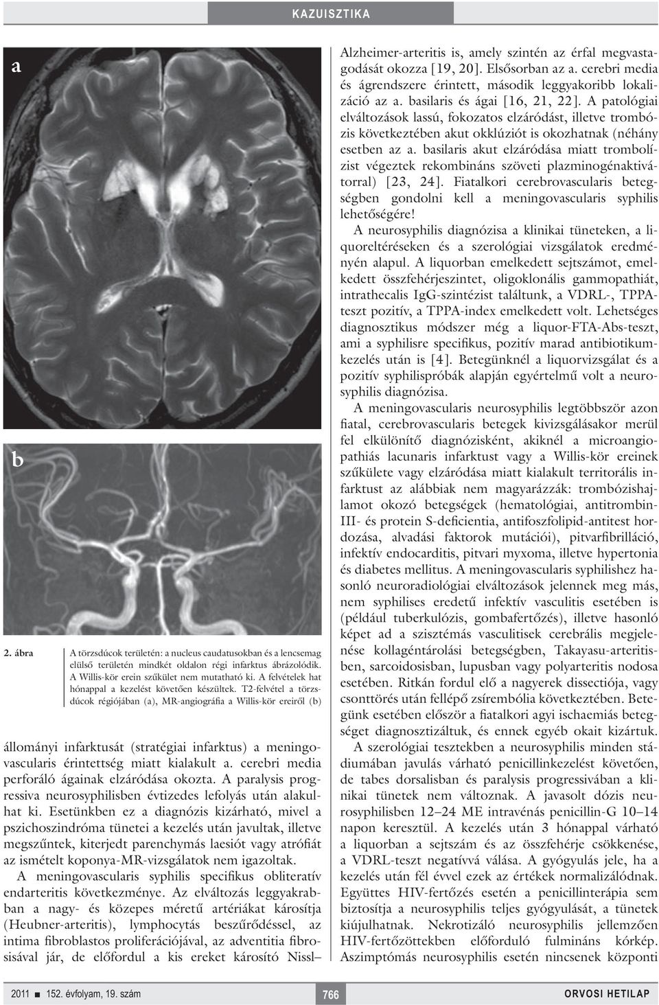 T2-felvétel a törzsdúcok régiójában (a), MR-angiográfia a Willis-kör ereiről (b) állományi infarktusát (stratégiai infarktus) a meningovascularis érintettség miatt kialakult a.