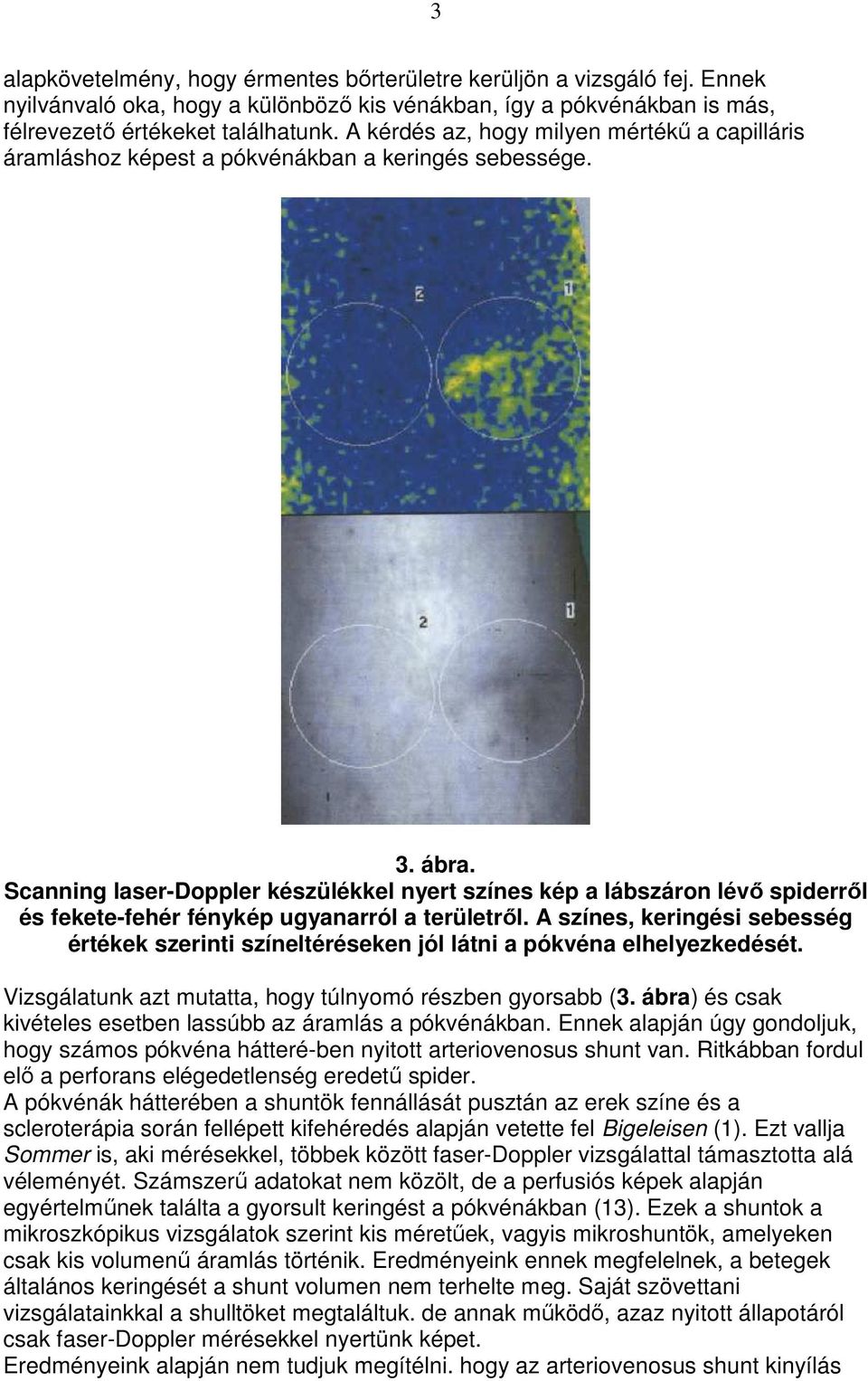 Scanning laser-doppler készülékkel nyert színes kép a lábszáron lévı spiderrıl és fekete-fehér fénykép ugyanarról a területrıl.