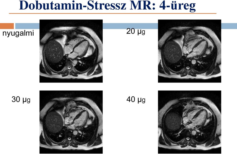 Dobutamin-Stressz MR: