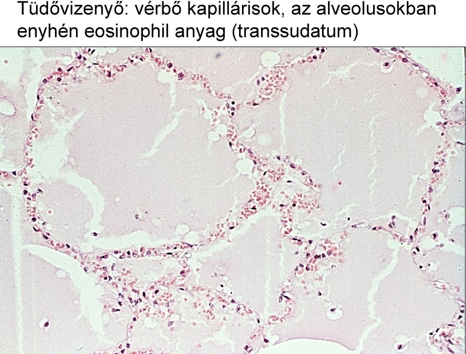 alveolusokban enyhén