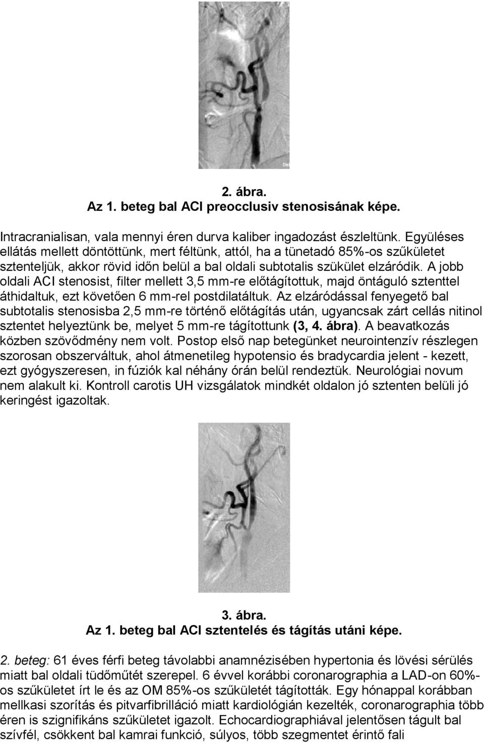 A jobb oldali ACI stenosist, filter mellett 3,5 mm-re előtágítottuk, majd öntáguló sztenttel áthidaltuk, ezt követően 6 mm-rel postdilatáltuk.